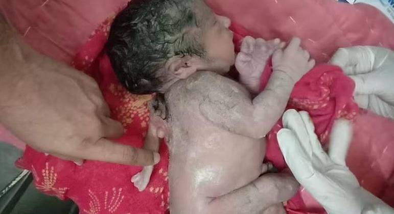 Imagens divulgadas nas redes mostram o bebê com o cordão umbilical preso ao corpo