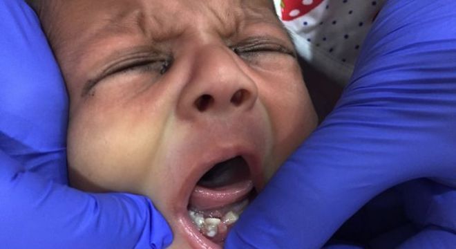 bebe nasce sete dentes