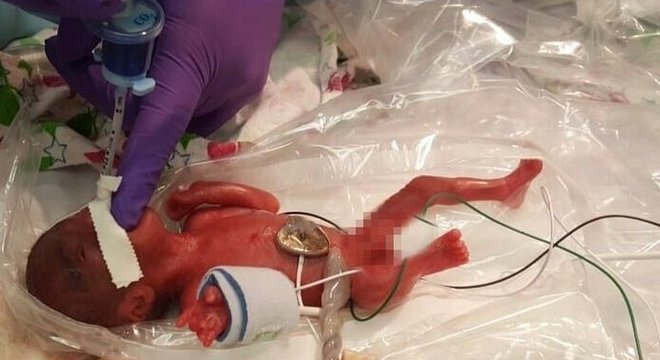  Logo após o parto prematuro, a menina cabia na palma da mão da equipe médica