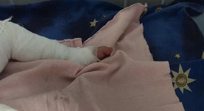 bebe queimadura banho