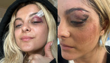 Bebe Rexha mostra o rosto após ser atingida por celular durante show 