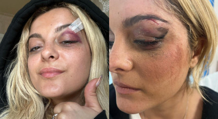 Bebe Rexha mostra rosto com 
pontos após ser atingida por celular em show