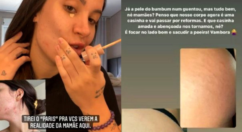 Bianca Andrade não teve vergonha de mostrar as estrias que ficaram na barriga dela durante a gestação do pequeno Cris. Além das marcas na barriga, ela mostrou que a pele dela se encheu de acne na época da gravidez