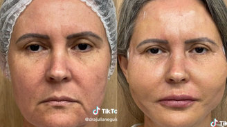 Mulher viraliza nas redes sociais com resultado de bichectomia (Reprodução/Instagram)