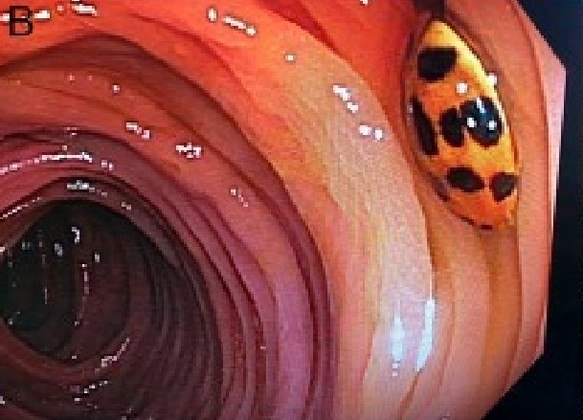 Um caso famoso foi registrado em 2019, quando médicos contemplaram uma joaninha no cólon do intestino de um paciente de 59 anos