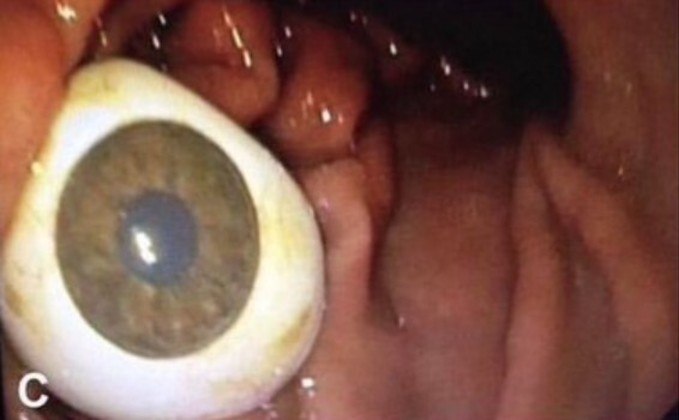 Em um caso sem muito contexto, um olho de vidro bastante atento foi achado no duodeno de um paciente de 85 anos