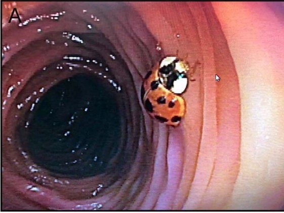 Ninguém sabe como o inseto foi parar tão longe no sistema digestivo do paciente e com uma aparência tão boa, a ponto de parecer vivaLEIA MAIS: Planeta Maluco: imagens de uma semana surpreendente em todo o mundo