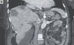 Testes de amostras de cocô e outros exames revelaram que o câncer se espalhou do cólon para o fígado, e seu tratamento seria apenas paliativoVEJA TAMBÉM: Mulher recebe ruídos do Chewbacca no celular após vingança de ex