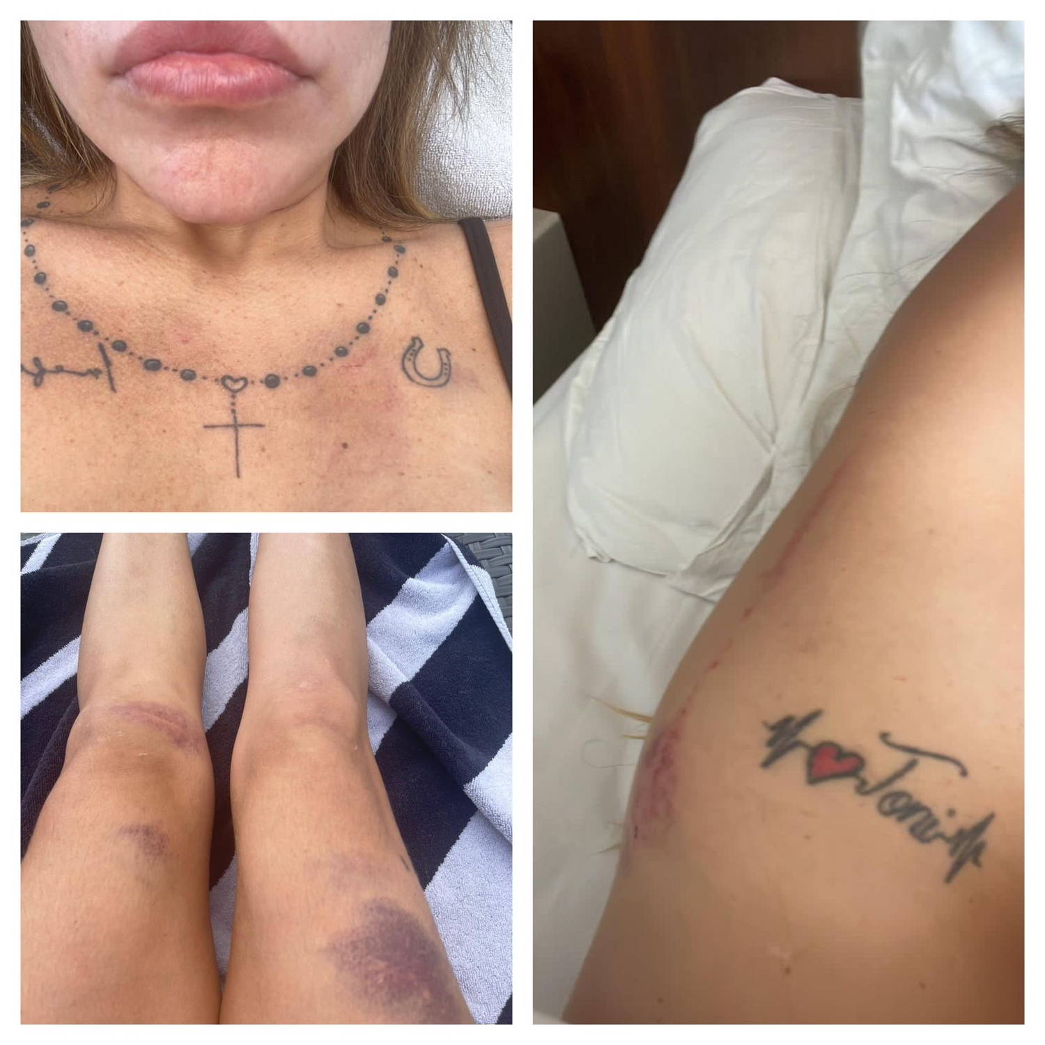 Liziane  arrumou briga com uma mulher e fraturou uma costela