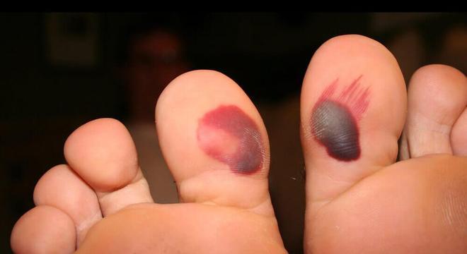 Bolha de sangue - como tratar, drenar ou estourar de forma segura