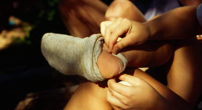 Bolha de sangue - como tratar, drenar ou estourar de forma segura