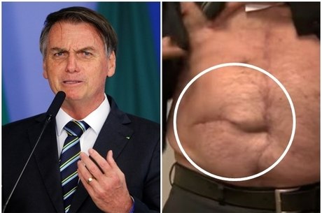 Entenda a cirurgia de hérnia incisional que Bolsonaro fará