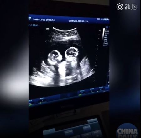 Um vídeo que viralizou na China mostra que desde o útero os gêmeos idênticos já estão tretando. Foi o que aconteceu na China, onde duas gêmeas do tipo foram flagradas pelo ultrassom brigando. O vídeo com o momento foi visto pelo menos 2,5 milhões de vezes, com 85 mil comentários