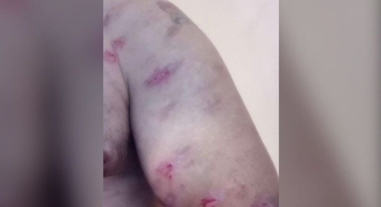 Britânico Russell Davies foi picado centenas de vezes por aranhas desde que se mudou, em 2020