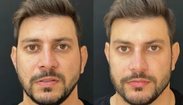 Caio Afiune faz harmonização facial: 'Ficou outra pessoa' (Reprodução/Instagram)