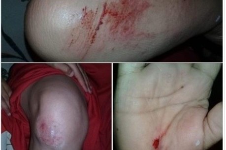 Maria postou nas redes sociais fotos dos ferimentos 
