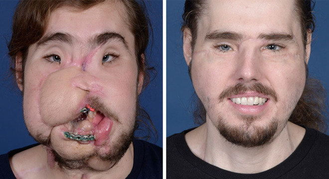 Cameron foi salvo com enxertos após a tentativa de suicídio (esq.) e conseguiu retomar sua vida após o transplante de rosto (dir.)