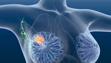 Tratamento inovador elimina totalmente o câncer de mama em estágio inicial 