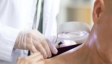 Tecnologia para tratar câncer de pele é aprovada para uso no SUS 
