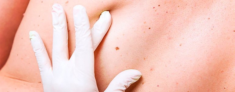 Câncer de pele -Segundo o Inca, é o tipo mais frequente no Brasil (27% do total) e no mundo. Sintomas: sinais que aparecem na pele (manchas, pintas, lesões). Observe cada parte da pele e procure o médico se verificar algo suspeito.  