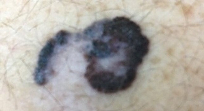 Melanoma é o tipo de câncer de pele menos comum e mais letal