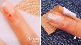 A woman develops skin cancer after cutting her toenails