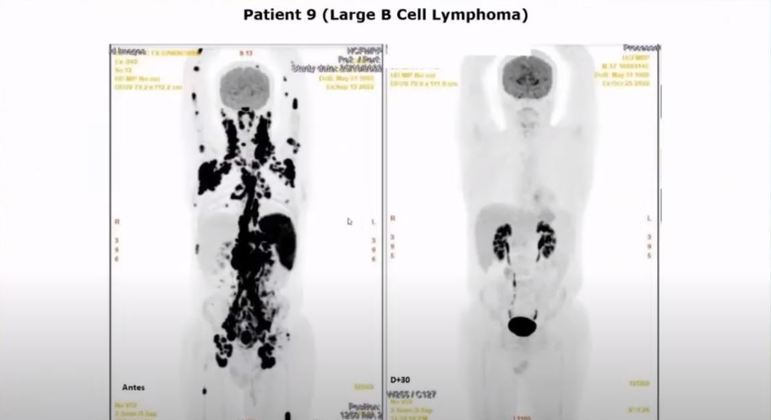 Exame mostra antes e depois do tratamento com células CAR-T