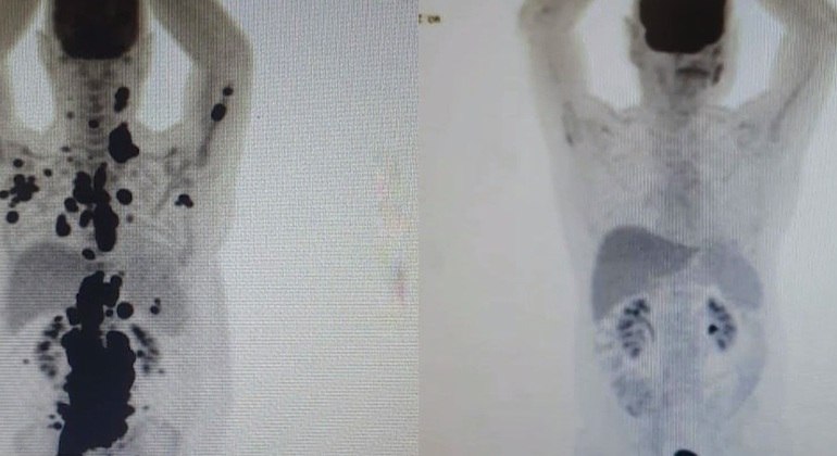 Imagens antes e depois do tratamento mostram o desaparecimento do câncer
