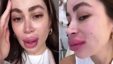 Carol Narizinho mostra boca inchada após retirar o preenchimento labial