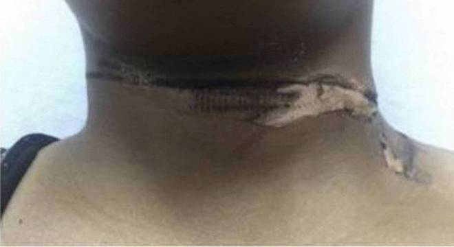 Jovem sofre queimadura de 2° grau ao usar carregador pirata de iPhone