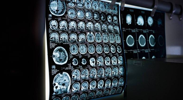 Pesquisadores analisaram o cérebro de 1.300 pessoas no estudo