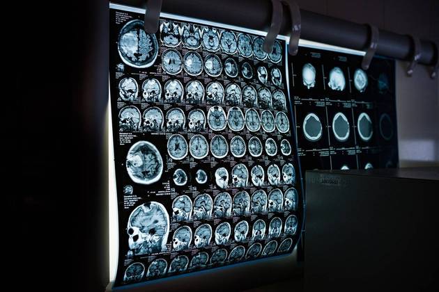 AcetilcolinaA acetilcolina desempenha funções relacionadas à memória, ao aprendizado
e à concentração, assim como ajuda na transmissão de
sinais entre nervos e músculos, ao permitir a contração de músculos, e regula
funções autônomas, como a frequência cardíaca e a digestão. Por fim, a diminuição dessa substância está relacionada a casos de Alzheimer