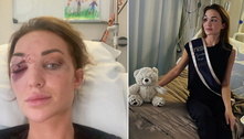 Miss Bélgica 2022 mostra rosto gravemente ferido após sofrer acidente de carro