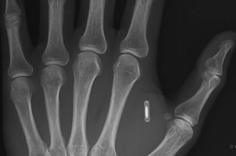 Biochips são implantados entre o polegar e o indicados, local que não tem terminações nervosas 