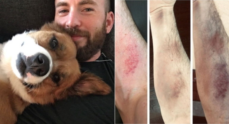 Chris Evans O intérprete do Capitão América estava gravando seu novo filme, chamado The Gray Man, quando machucou o braço. Apesar de não ter dado detalhes de como tudo aconteceu, ele mostrou o tamanho do hematoma: 