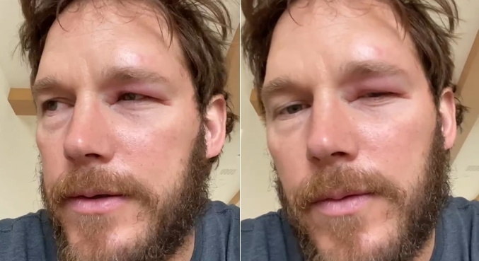 Olho de Chris Pratt ficou inchado com picada de abelha