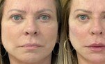 A apresentadora Christina Rocha, de 65 anos, também passou por uma harmonização facial e preenchimento de malar, mento, labial, rinomodelação e aplicação de toxina botulínica — popularmente conhecida como Botox