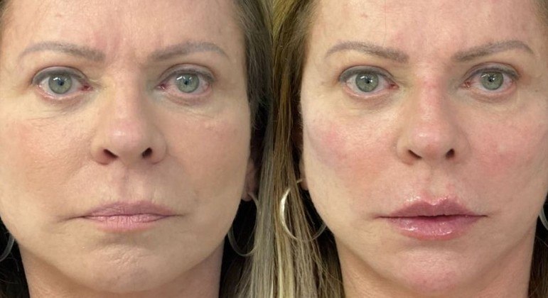 Christina Rocha antes e depois de fazer harmonização facial