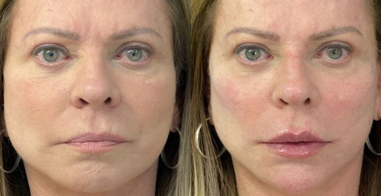 A apresentadora Christina Rocha, de 65 anos, também passou por uma harmonização facial e preenchimento de malar, mento, labial, rinomodelação e aplicação de toxina botulínica — popularmente conhecida como Botox