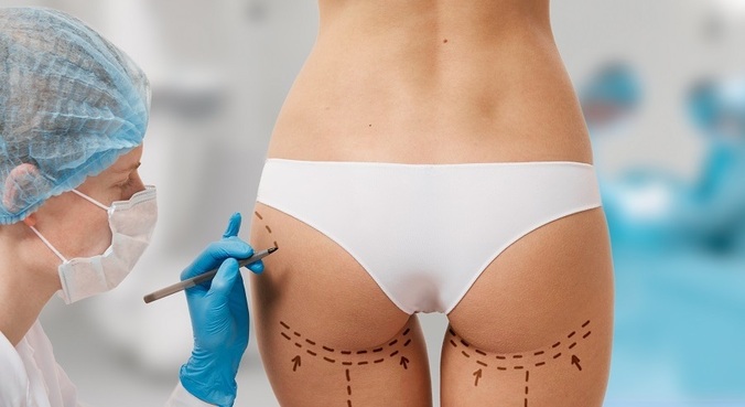 Cirurgia do 'bumbum à brasileira' é feita para aumentar os glúteos