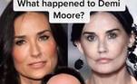 Recentemente, Demi Moore causou polêmica ao aparecer em um desfile com o rosto extremamente marcado. Segundo o médico, a atriz passou por um facelift. 
