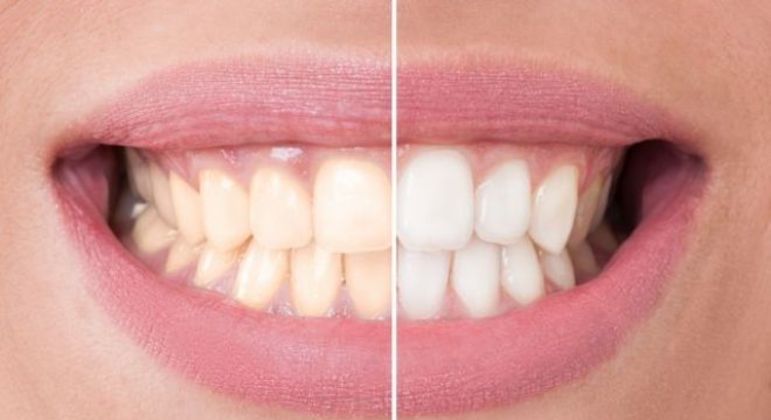 Clareamento dental: Confira alguns mitos sobre o tratamento