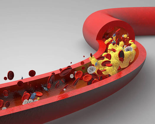 colesterol-sangue-veia-gordura