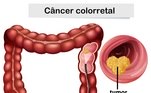 Faça acompanhamento médicoA realização periódica de colonoscopia a partir dos 45 anos é uma forma de detectar lesões pré-cancerígenas antes de elas virarem tumores. Removê-las no momento certo reduz significativamente o risco de câncer colorretal. A colonoscopia é um exame rápido, feito sob sedação, que utiliza uma câmera para analisar o cólon e o reto. Em caso de pólipos, o médico consegue fazer a retirada durante o procedimento