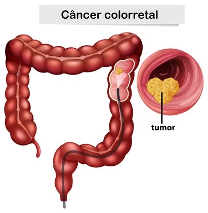 Faça acompanhamento médicoA realização periódica de colonoscopia a partir dos 45 anos é uma forma de detectar lesões pré-cancerígenas antes de elas virarem tumores. Removê-las no momento certo reduz significativamente o risco de câncer colorretal. A colonoscopia é um exame rápido, feito sob sedação, que utiliza uma câmera para analisar o cólon e o reto. Em caso de pólipos, o médico consegue fazer a retirada durante o procedimento