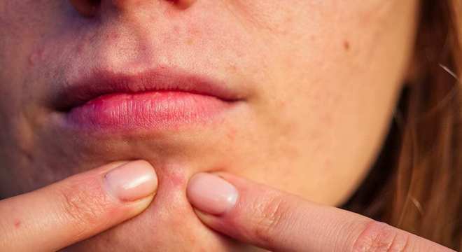 Como secar espinha- 8 tratamentos caseiros eficazes para acabar com ela