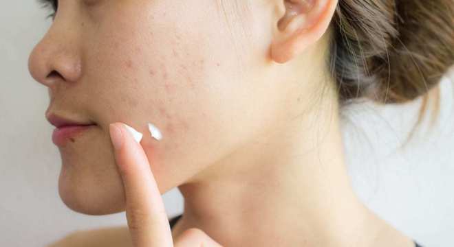 Como secar espinha- 8 tratamentos caseiros eficazes para acabar com ela