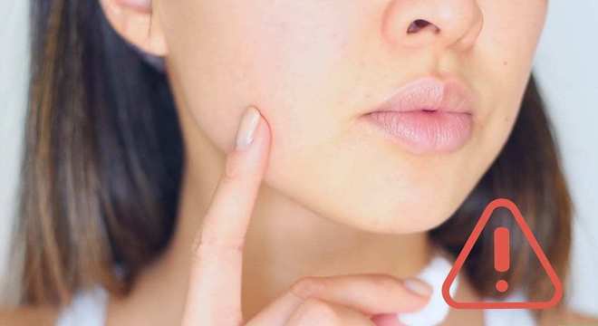 Como secar espinha- 8 tratamentos caseiros eficazes para acabar com ela