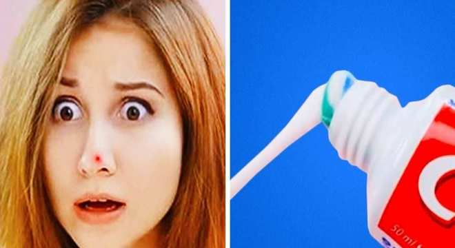 Como secar espinha- 8 tratamentos caseiros eficazes para acabar com ela