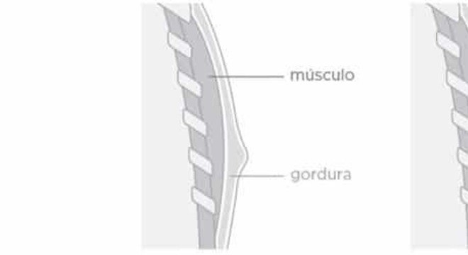 Como trarar a Ginecomastia